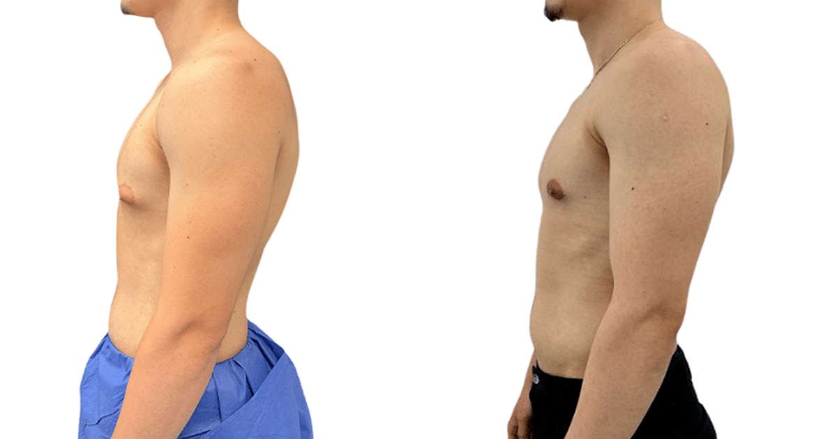 Gynecomastia vs Fat