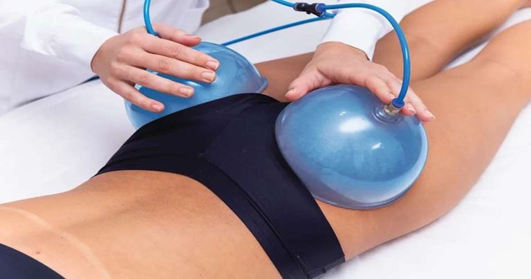 Butt Cupping: (procedure, Benefits, And Safety Precautions)